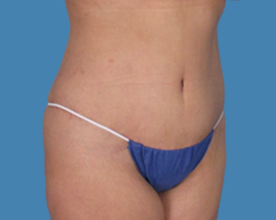 After Image: LipoTuck, Tummy Tuck - front
