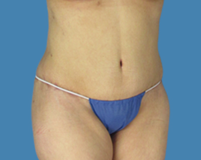 After Image: LipoTuck, Tummy Tuck, Plus-Size Tummy Tuck - front