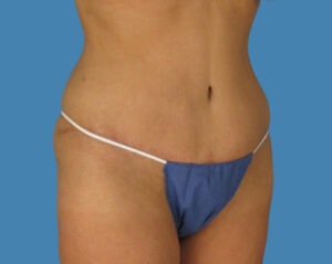 After Image: LipoTuck, Tummy Tuck, Plus-Size Tummy Tuck