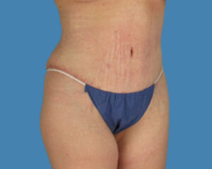 After Image: LipoTuck, Tummy Tuck