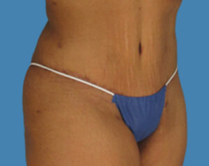 After Image: LipoTuck, Tummy Tuck