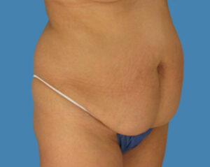 Before Image: LipoTuck, Tummy Tuck, Plus-Size Tummy Tuck