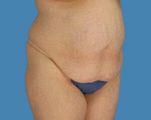 Before Image: LipoTuck, Tummy Tuck