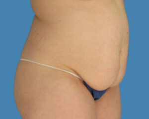 Before Image: LipoTuck, Tummy Tuck