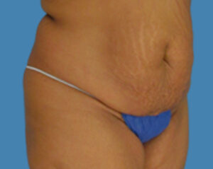 Before Image: LipoTuck, Tummy Tuck